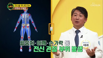 중년의 고질병.. '퇴행성관절염' 원인부터 알자!!