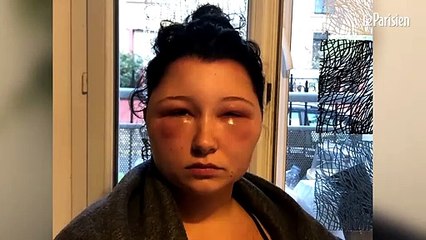 ¡Una mujer sufre una terrible deformación craneal tras teñirse el pelo!