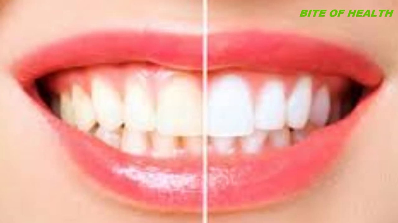Teeth Whitening At Home In 3 Minutes || How To Whiten Your Yellow Teeth Naturally || 100% Effective