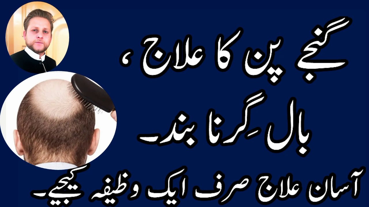 Girte Balon ka Ilaj [Treatment for Hair Loss] [ Girte Balon ka Wazifa ] By M younas in Urdu/Hindi.