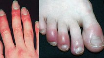 Winters में हाथ पैर की उंगलियों में होती है Swelling, तो ऐसे रखें ख्याल | Boldsky