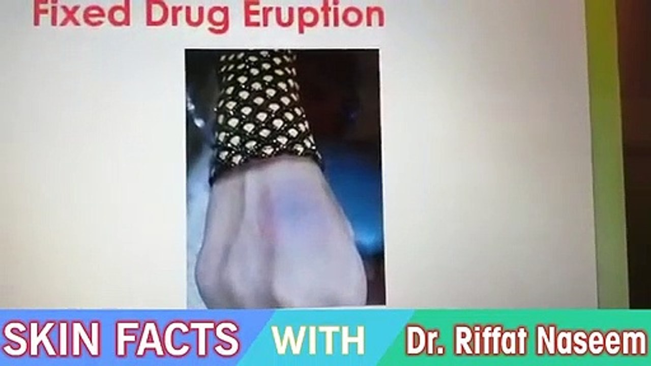 Drug Reactions