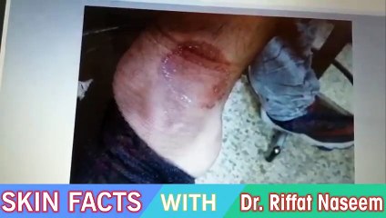 Tinea Corporis in Urdu and Hindi