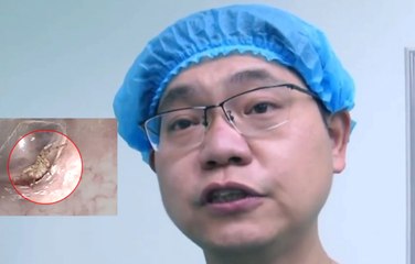 El doctor descubre que la araña tejía su tela dentro de la oreja del paciente con dolor de oídos