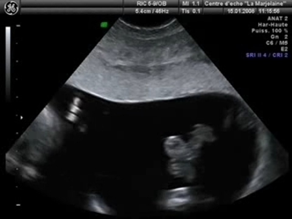 Echographie Maud (15.01.08)