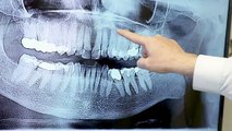 dental implants worcester - Common Park Dental