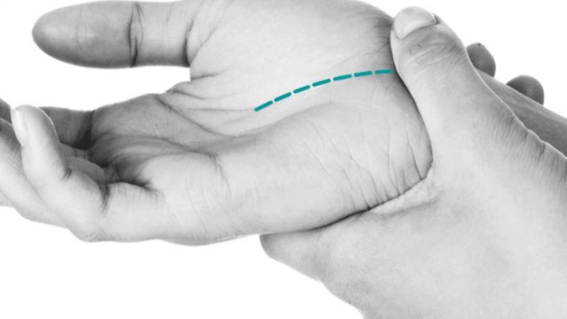 bd-tunel-carpal-070120