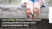 This 10-Year-Old's Feet Were Covered in Green and Black Lesions After Insects Infested Her Skin