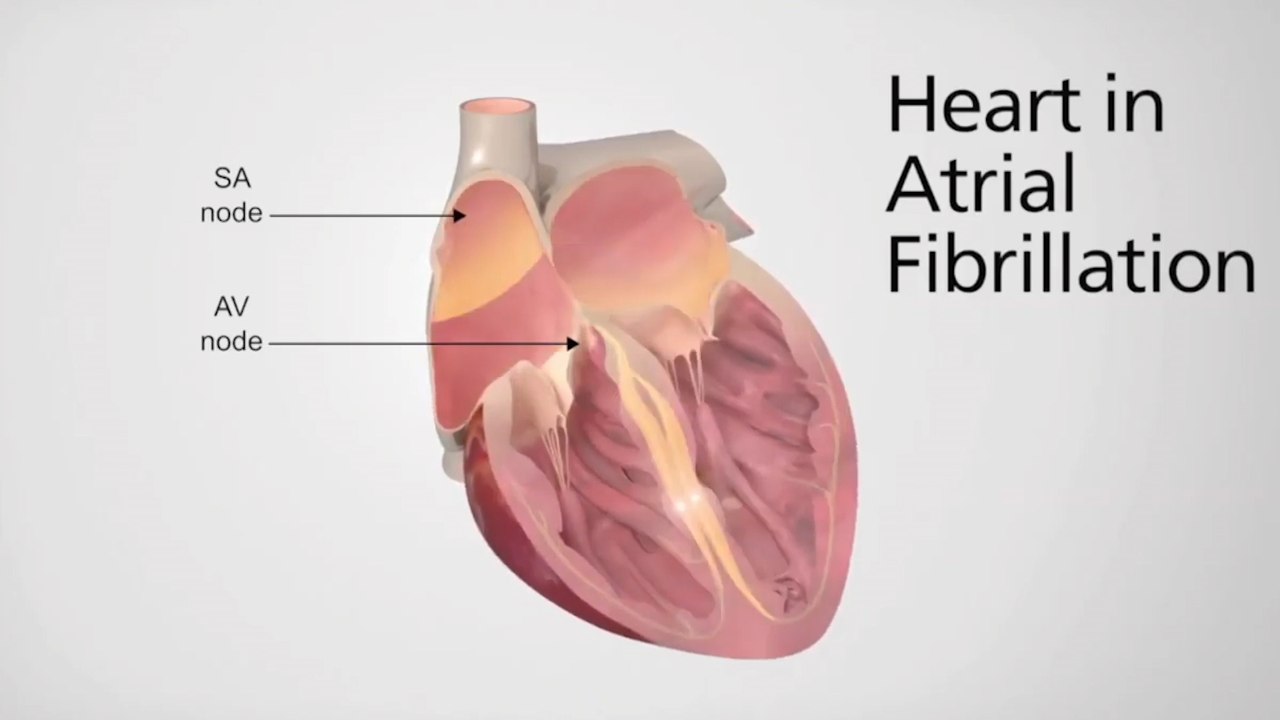 New AFIB Treatment Options with CardioVascular Institute of Scottsdale