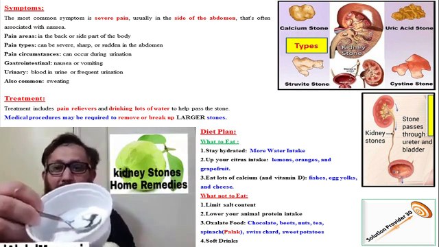 Kidney Stone Treatment and Removal Using Guava & Baking soda - 100% working