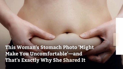 This Woman's Stomach Photo 'Might Make You Uncomfortable'—and That's Exactly Why She Shared It