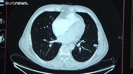 Kampf gegen Lungenkrebs: 500 Leben retten dank Früherkennung