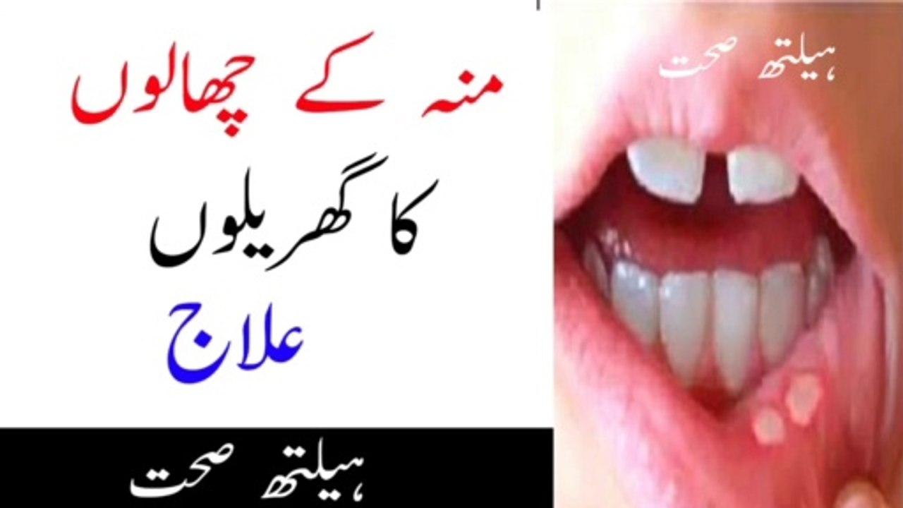 منہ کے چھالوں کا دیسی علاج |mu kai chalo ka desi ilaj|zuban kai chalo ka gharilo ilaj