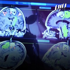 الكركم … أمل جديد لعلاج السرطان