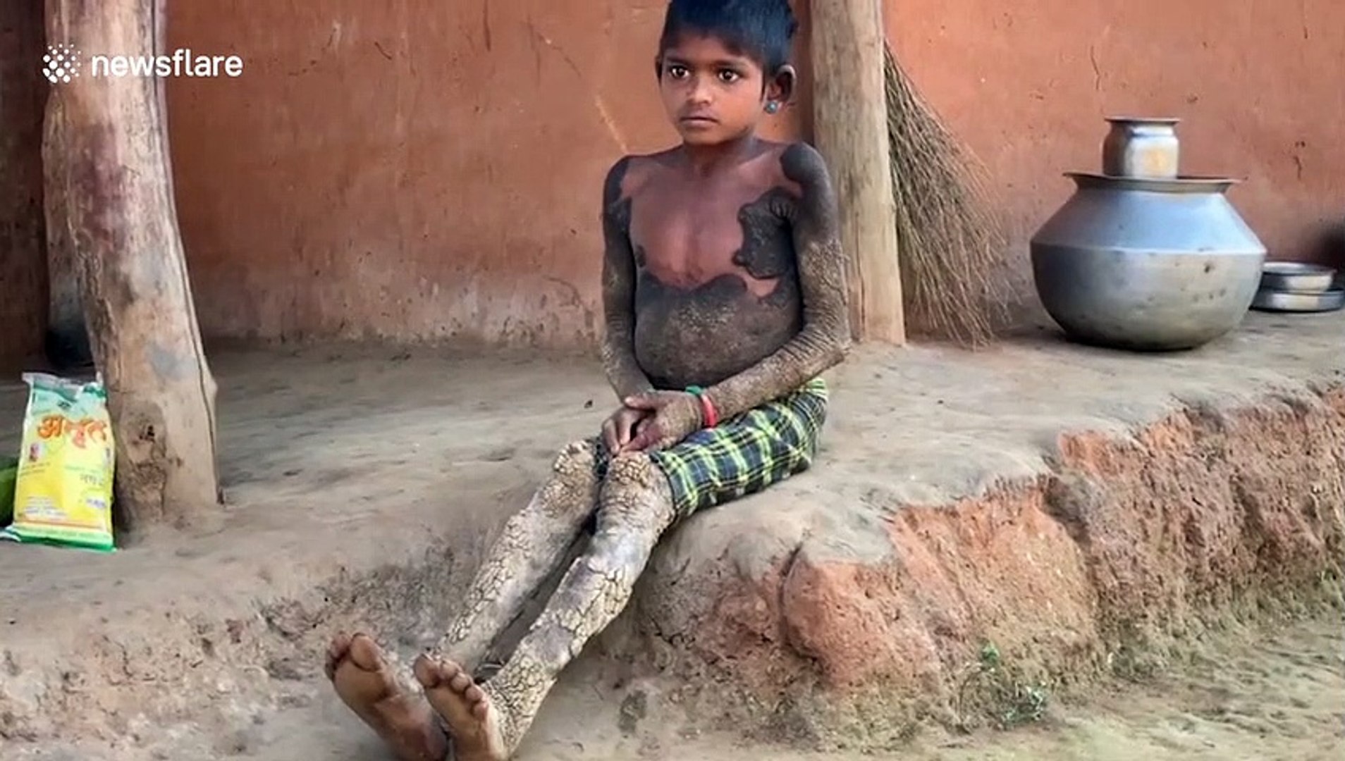 Rare Genetic Disorder Causes Girl S Skin To Turn To Tree Bark In Central India Video Dailymotion