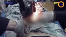 Les médecins libèrent avec une scie ses parties intimes coincées dans un anneau