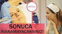 Hydrafacial uygulaması | Peri Tozu