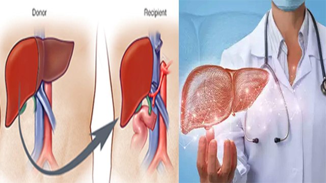 Transplant के लिए पूरा नही निकाला जाता Liver, Liver Transplant से पहले जान ले ये जरुरी बातें।Boldsky