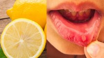 मुंह के छालों Mouth Ulcers का घरेलू उपचार | मुंह के छाले इस नुस्खे से तुरंत ठीक होंगे | Boldsky