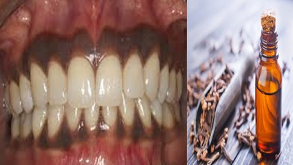 काले मसूड़े होने का कारण और इलाज | Know the Reason and Treatments of Gums Black | Boldsky