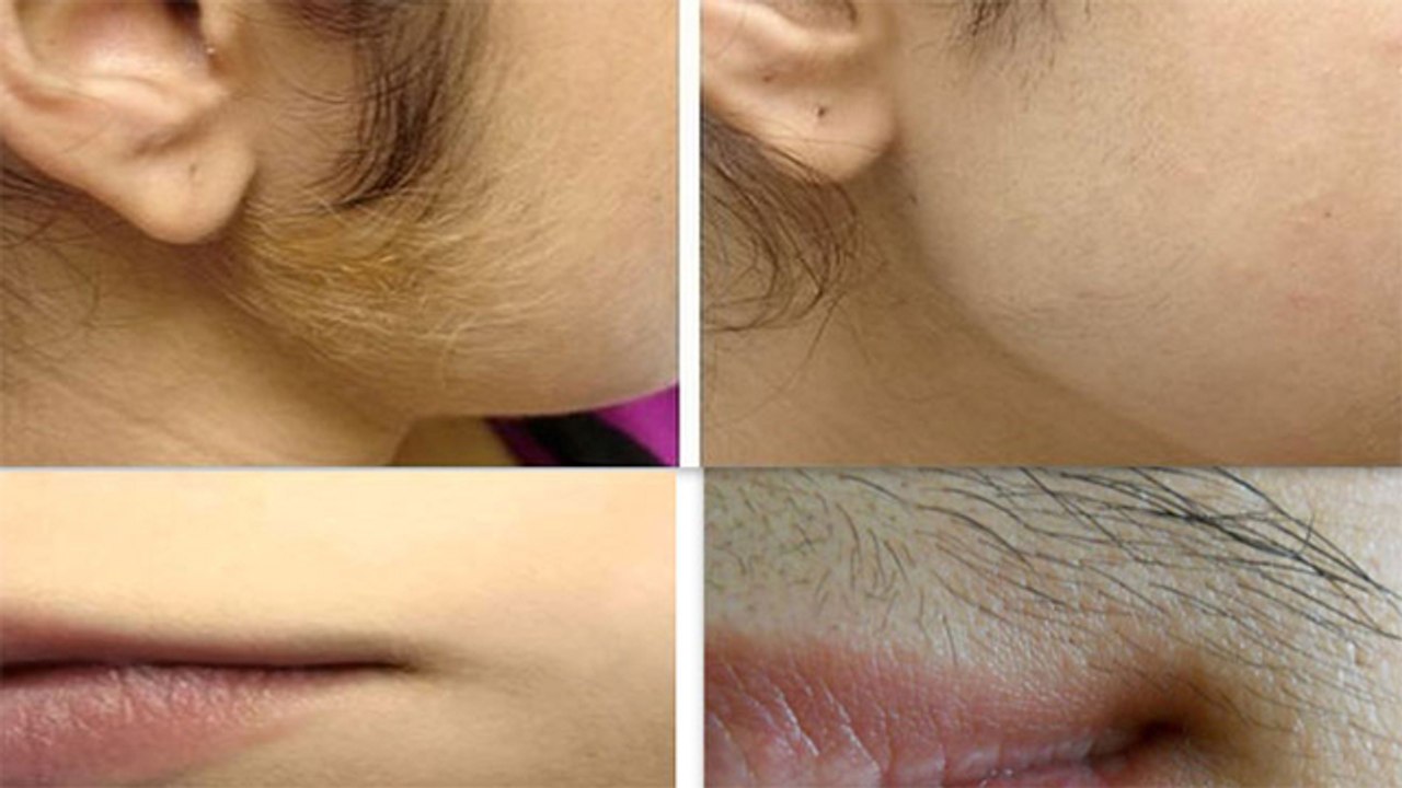अनचाहे बालों से  Permanent  छुटकारे के लिए करें ये घरेलू उपाए । Remove Unwanted Hair । Boldsky
