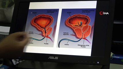 70 ve üstü yaş erkeklerde prostata dikkat