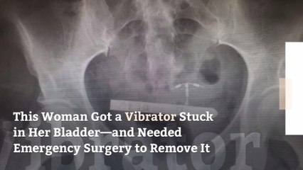 This Woman Got a Vibrator Stuck in Her Bladder—and Needed Emergency Surgery to Remove It