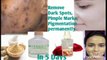 How to get rid from Dark Spot, Pimple Marks,  Pigmentation, Remove permanently within 5days only| Apply regular and get clean skin| 1 Remedy solve all skin problems| Natural home made treatment | Don't invest so much money in chemical products| benatural