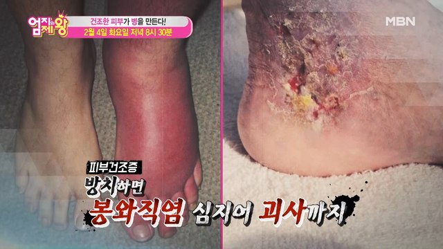 엄지의 제왕 368회 [건조한 피부가 병을 만든다!]