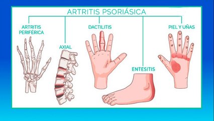 bd-artritis-psoriasica-190521