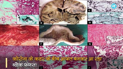 Corona के बाद अब Black Fungus की चपेट में आ रहा देश, दिल्ली से लेकर तेलंगाना तक खौफ में लोग!