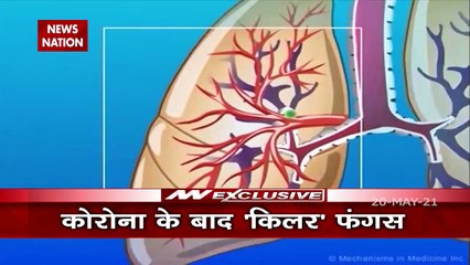 Delhi HC orders the central govt to import medicines of black fungas