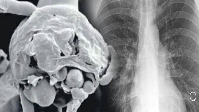 White Fungus है बेहद खतरनाक, जानें क्या है इसके लक्षण |Symptoms of White Fungus | Boldsky