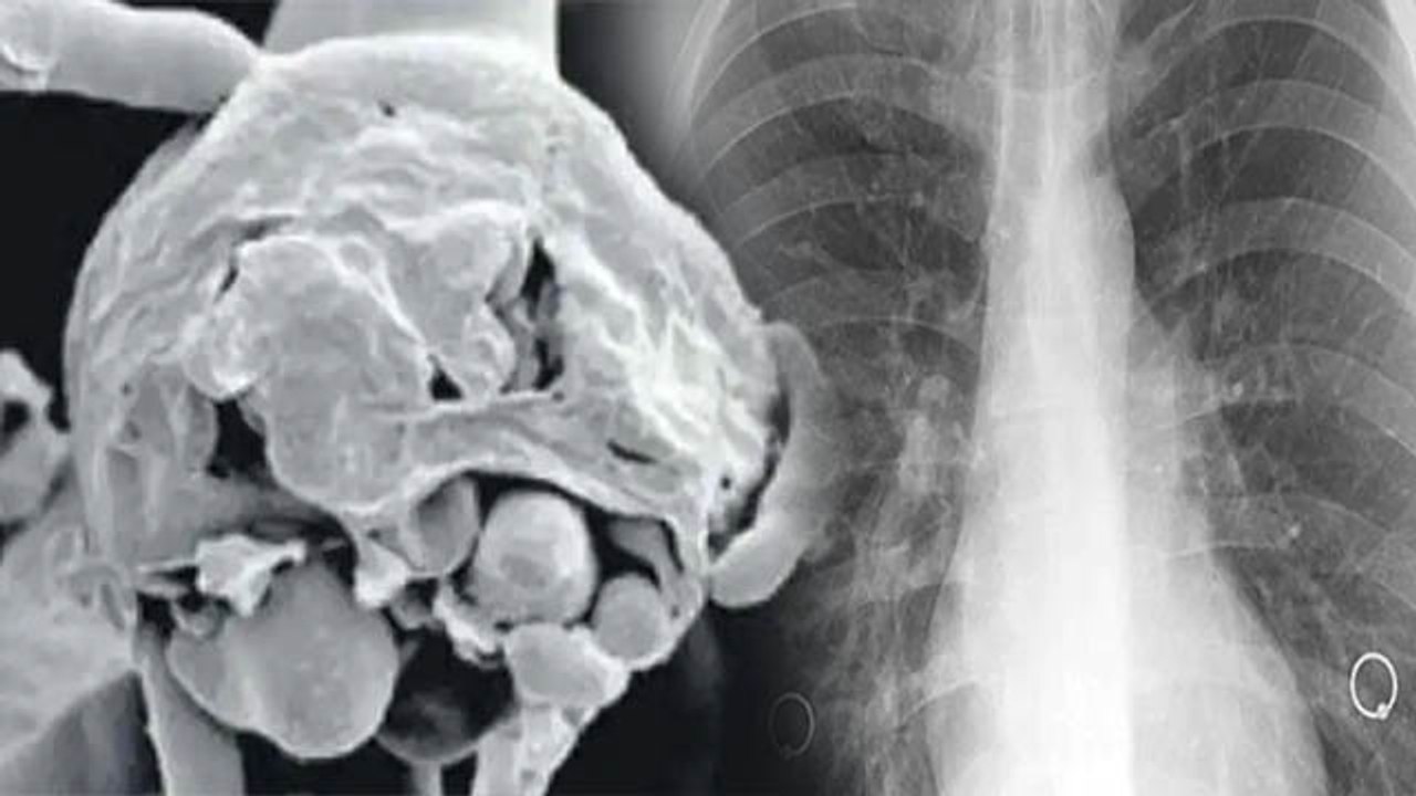 White Fungus है बेहद खतरनाक, जानें क्या है इसके लक्षण |Symptoms of White Fungus | Boldsky