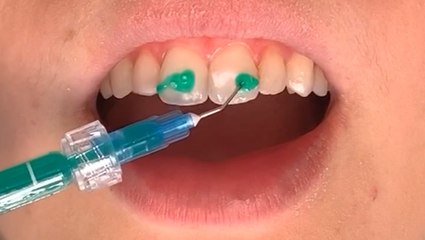 How white spots on teeth are removed