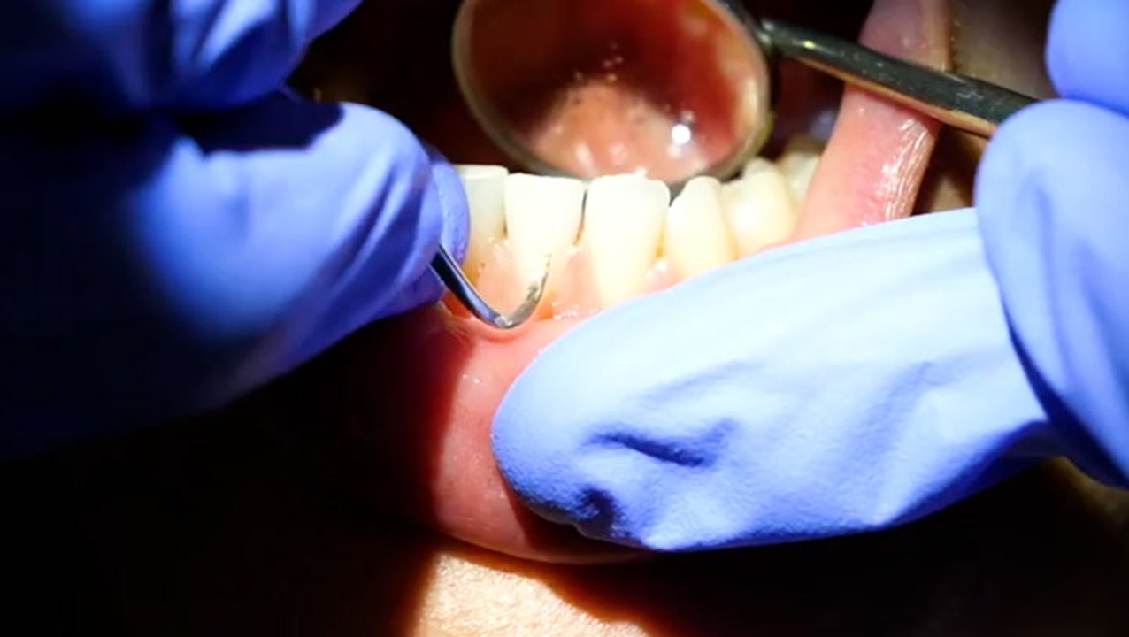 How buildup is satisfyingly removed from teeth