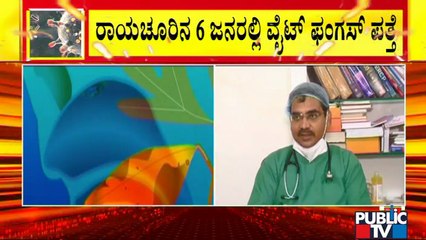 ರಾಯಚೂರಿನ ಖಾಸಗಿ ಆಸ್ಪತ್ರೆಯಲ್ಲಿ 6 ಮಂದಿಯಲ್ಲಿ ವೈಟ್ ಫಂಗಸ್ ಪತ್ತೆ | White Fungus | Raichur