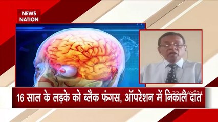 First case of Black fungus in child, know the way of prevention