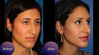 Nose Job Before & After Photos Of Nyc Patients