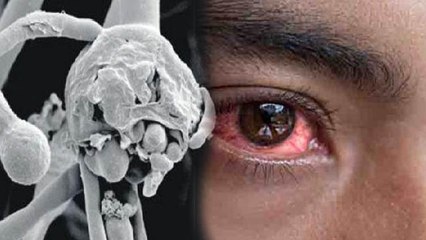 Black Fungus क्यों लेता जा रहा है महामारी का रूप,जानिए इस जानलेवा बीमारी के बारें में । Boldsky