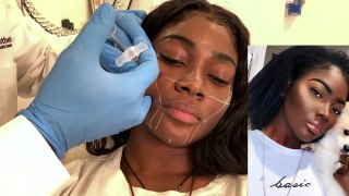 A Black Girls Guide To Getting Fillers!! F*K The Stigma ..
