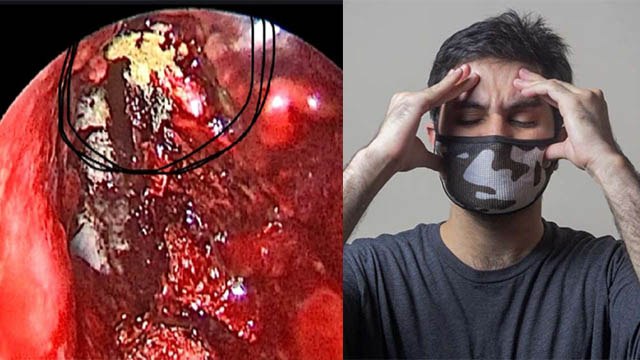 Yellow Fungus का Symptoms जान लें, ये लक्षण दिखने पर तुरंत जांच जरूरी | Boldsky