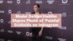 Model Delilah Hamlin Shares Photo of 'Painful' Scoliosis on Instagram