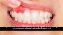 Diş Eti Hastalıkları Periodontoloji