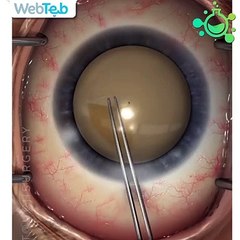 كيف يتم إجراء جراحة الساد أو المياه البيضاء في العين؟