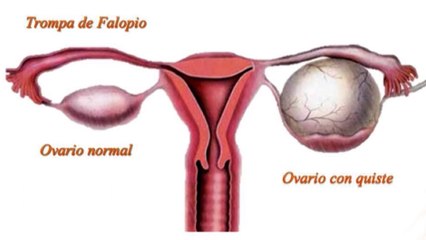 bd-necesidad-de-extirpar-el-utero-110220