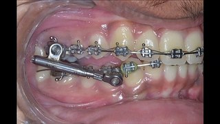 OVERBITE TEETH AND BUCK TEETH CORRECTION.. ADULT BRACES,BRACES BEFORE AFTER