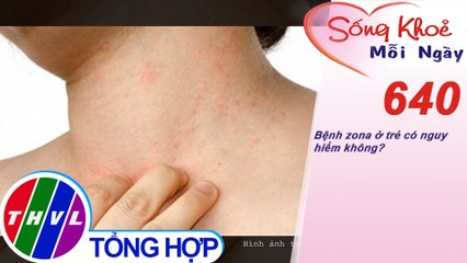 Bệnh zona ở trẻ có nguy hiểm không? | Sống khỏe mỗi ngày - Kỳ 640