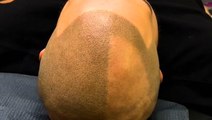 Scalp tattoos create the appearance of hair