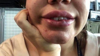 Dudak dolgusu hayatını kararttı